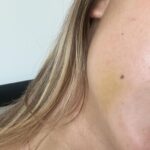 Elliana Walmsley Instagram - wisdom teeth = gone