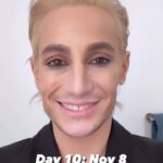 Frankie Grande Instagram - My 10-day @laseraway Botox journey 😘 How do I look?