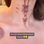 Gabbie Hanna Instagram – Yes, it hurts 🥰  #tattooremoval #tattoos