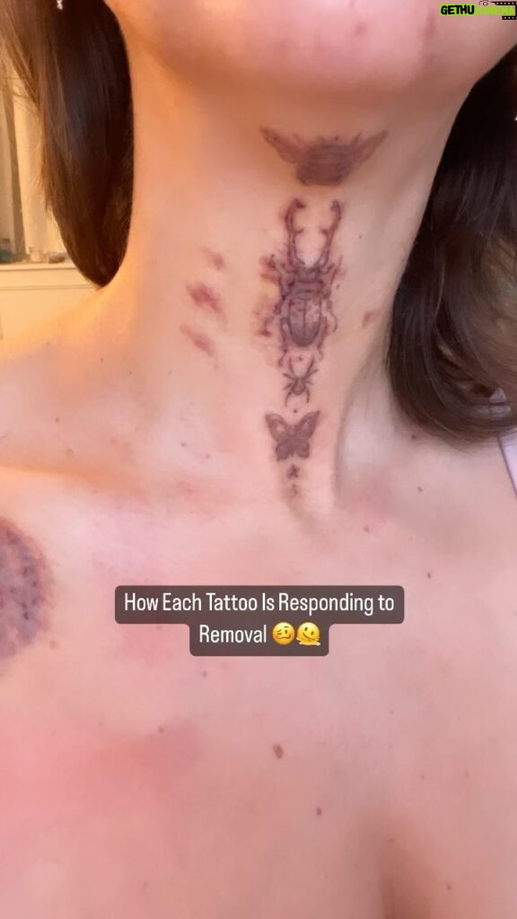 Gabbie Hanna Instagram - Yes, it hurts 🥰 #tattooremoval #tattoos