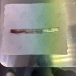 Hafþór Júlíus Björnsson Instagram – WARNING GRAPHIC SURGERY FOOTAGE. Live on my YouTube channel. Wednesday I’m 4 weeks post surgery. Sadly I got an infection 5 days ago resulting in an abscess and had to have a drainage tube inserted.  Finally had that removed today. Swipe to see the length of it! 🤯
