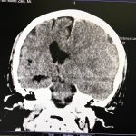 Hanis Zalikha Instagram - Kalau anyone you know jatuh kepala terhentak, luaran memang takde apa tapi dalaman maybe boleh jadi pendarahan perlahan. Sejurus dari terjatuh, bila check X-Ray dan CT scan it will tell you nothing, semua clear saja, but 2-3weeks later could turn into your biggest nightmare when the blood has flooded a big part of your brain. My dad realised something was wrong hampir sebulan lepas jatuh, when suddenly he couldn’t really move his right leg. Macam lagging. Sebab dia jatuh terhentak dahi kiri, bila anggota belah kanan yang terjejas, we knew it must be the brain. I picked him up and asked about his very very recent trip to Acheh, he said “Bila Daddy pergi Acheh?”. Ya Allah this very man, is my dad, someone who was very sharp and opinionated, tiba-tiba sangat blur dan slow, jawab sepatah-sepatah. So I spent the whole day uruskan dia, consulted two specialists and one neurosurgeon and when he is finally admitted that night to prepare him for his surgery the following day, he told the family “Daddy tadi drive sendiri datang sini”. My heart sank, I was frantic with worry — takutnya lagi lambat ni lagi banyak memori dia hilang. The brain surgery went well atas izin Allah, thank you to everyone involved. Doktor kata kalau lewat sikit je lagi memang boleh hilang keupayaan bercakap, keupayaan bernafas dan seterusnya koma, sebab otak dah compressed terlalu banyak darah. I jot this here as a reminder for all of us to always jangan tangguh-tangguh kalau hati dah tergerak. Daddy masih tak ingat I bawak dia pi hospital hari tu. Nasib baik kita selfie.