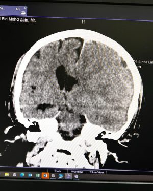 Hanis Zalikha Instagram - Kalau anyone you know jatuh kepala terhentak, luaran memang takde apa tapi dalaman maybe boleh jadi pendarahan perlahan. Sejurus dari terjatuh, bila check X-Ray dan CT scan it will tell you nothing, semua clear saja, but 2-3weeks later could turn into your biggest nightmare when the blood has flooded a big part of your brain.

My dad realised something was wrong hampir sebulan lepas jatuh, when suddenly he couldn’t really move his right leg. Macam lagging. Sebab dia jatuh terhentak dahi kiri, bila anggota belah kanan yang terjejas, we knew it must be the brain. 

I picked him up and asked about his very very recent trip to Acheh, he said “Bila Daddy pergi Acheh?”. Ya Allah this very man, is my dad, someone who was very sharp and opinionated, tiba-tiba sangat blur dan slow, jawab sepatah-sepatah.

So I spent the whole day uruskan dia, consulted two specialists and one neurosurgeon and when he is finally admitted that night to prepare him for his surgery the following day, he told the family “Daddy tadi drive sendiri datang sini”. My heart sank, I was frantic with worry — takutnya lagi lambat ni lagi banyak memori dia hilang.

The brain surgery went well atas izin Allah, thank you to everyone involved. Doktor kata kalau lewat sikit je lagi memang boleh hilang keupayaan bercakap, keupayaan bernafas dan seterusnya koma, sebab otak dah compressed terlalu banyak darah.

I jot this here as a reminder for all of us to always jangan tangguh-tangguh kalau hati dah tergerak.

Daddy masih tak ingat I bawak dia pi hospital hari tu. Nasib baik kita selfie.