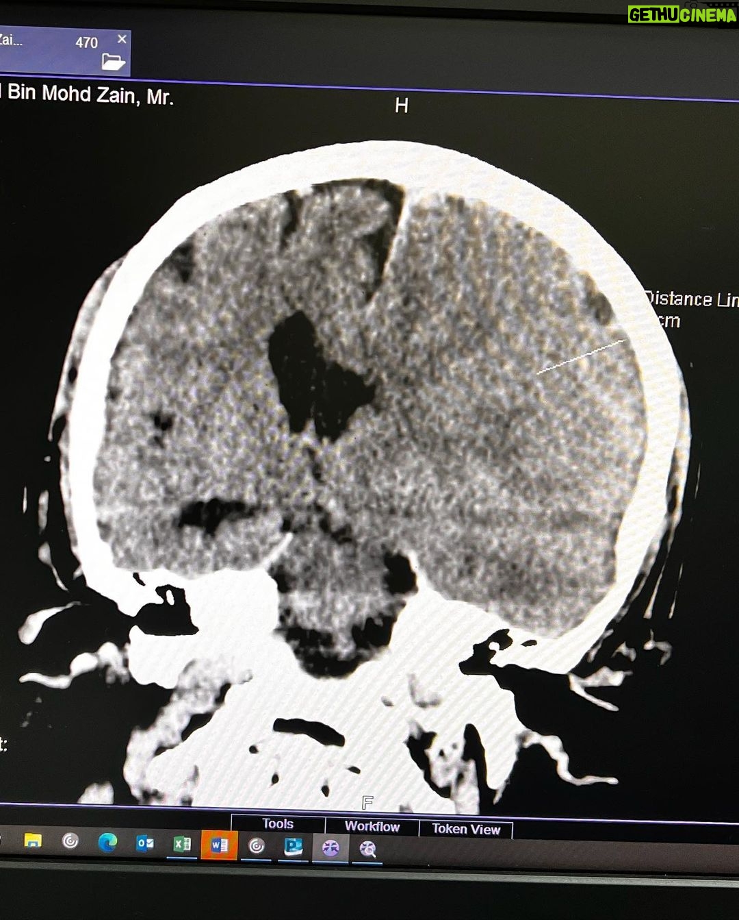 Hanis Zalikha - 168.1K Likes - Kalau anyone you know jatuh kepala terhentak, luaran memang takde apa tapi dalaman maybe boleh jadi pendarahan perlahan. Sejurus dari terjatuh, bila check X-Ray dan CT scan it will tell you nothing, semua clear saja, but 2-3weeks later could turn into your biggest nightmare when the blood has flooded a big part of your brain.
My dad realised something was wrong hampir sebulan lepas jatuh, when suddenly he couldn’t really move his right leg. Macam lagging. Sebab dia jatuh terhentak dahi kiri, bila anggota belah kanan yang terjejas, we knew it must be the brain.
I picked him up and asked about his very very recent trip to Acheh, he said “Bila Daddy pergi Acheh?”. Ya Allah this very man, is my dad, someone who was very sharp and opinionated, tiba-tiba sangat blur dan slow, jawab sepatah-sepatah.
So I spent the whole day uruskan dia, consulted two specialists and one neurosurgeon and when he is finally admitted that night to prepare him for his surgery the following day, he told the family “Daddy tadi drive sendiri datang sini”. My heart sank, I was frantic with worry — takutnya lagi lambat ni lagi banyak memori dia hilang.
The brain surgery went well atas izin Allah, thank you to everyone involved. Doktor kata kalau lewat sikit je lagi memang boleh hilang keupayaan bercakap, keupayaan bernafas dan seterusnya koma, sebab otak dah compressed terlalu banyak darah.
I jot this here as a reminder for all of us to always jangan tangguh-tangguh kalau hati dah tergerak.
Daddy masih tak ingat I bawak dia pi hospital hari tu. Nasib baik kita selfie.