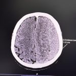 Hanis Zalikha Instagram - Kalau anyone you know jatuh kepala terhentak, luaran memang takde apa tapi dalaman maybe boleh jadi pendarahan perlahan. Sejurus dari terjatuh, bila check X-Ray dan CT scan it will tell you nothing, semua clear saja, but 2-3weeks later could turn into your biggest nightmare when the blood has flooded a big part of your brain. My dad realised something was wrong hampir sebulan lepas jatuh, when suddenly he couldn’t really move his right leg. Macam lagging. Sebab dia jatuh terhentak dahi kiri, bila anggota belah kanan yang terjejas, we knew it must be the brain. I picked him up and asked about his very very recent trip to Acheh, he said “Bila Daddy pergi Acheh?”. Ya Allah this very man, is my dad, someone who was very sharp and opinionated, tiba-tiba sangat blur dan slow, jawab sepatah-sepatah. So I spent the whole day uruskan dia, consulted two specialists and one neurosurgeon and when he is finally admitted that night to prepare him for his surgery the following day, he told the family “Daddy tadi drive sendiri datang sini”. My heart sank, I was frantic with worry — takutnya lagi lambat ni lagi banyak memori dia hilang. The brain surgery went well atas izin Allah, thank you to everyone involved. Doktor kata kalau lewat sikit je lagi memang boleh hilang keupayaan bercakap, keupayaan bernafas dan seterusnya koma, sebab otak dah compressed terlalu banyak darah. I jot this here as a reminder for all of us to always jangan tangguh-tangguh kalau hati dah tergerak. Daddy masih tak ingat I bawak dia pi hospital hari tu. Nasib baik kita selfie.