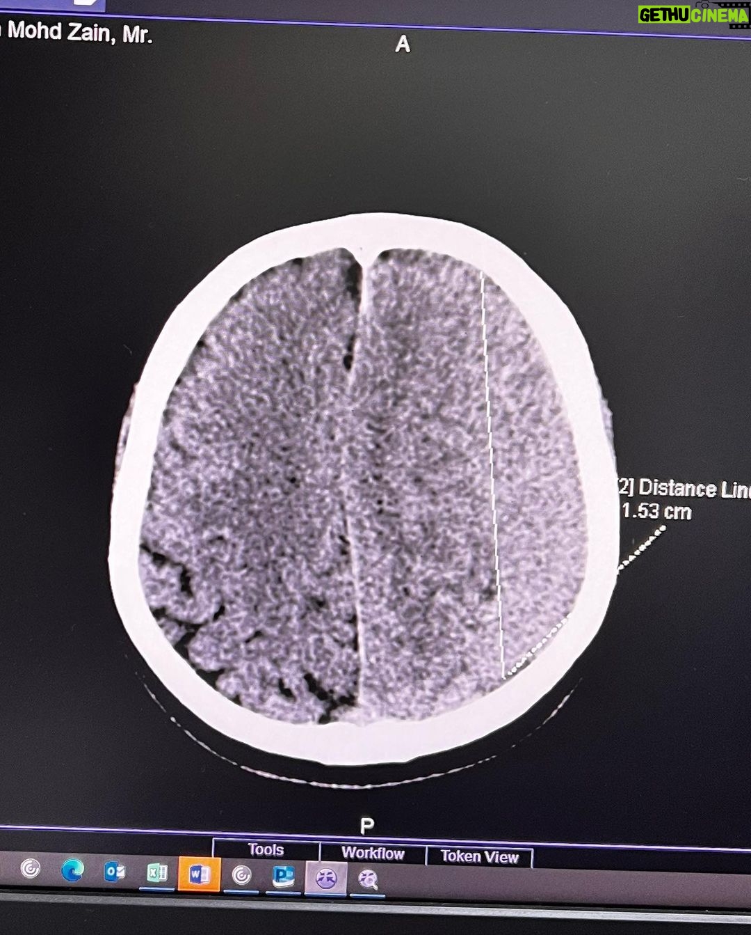 Hanis Zalikha - 168.1K Likes - Kalau anyone you know jatuh kepala terhentak, luaran memang takde apa tapi dalaman maybe boleh jadi pendarahan perlahan. Sejurus dari terjatuh, bila check X-Ray dan CT scan it will tell you nothing, semua clear saja, but 2-3weeks later could turn into your biggest nightmare when the blood has flooded a big part of your brain.
My dad realised something was wrong hampir sebulan lepas jatuh, when suddenly he couldn’t really move his right leg. Macam lagging. Sebab dia jatuh terhentak dahi kiri, bila anggota belah kanan yang terjejas, we knew it must be the brain.
I picked him up and asked about his very very recent trip to Acheh, he said “Bila Daddy pergi Acheh?”. Ya Allah this very man, is my dad, someone who was very sharp and opinionated, tiba-tiba sangat blur dan slow, jawab sepatah-sepatah.
So I spent the whole day uruskan dia, consulted two specialists and one neurosurgeon and when he is finally admitted that night to prepare him for his surgery the following day, he told the family “Daddy tadi drive sendiri datang sini”. My heart sank, I was frantic with worry — takutnya lagi lambat ni lagi banyak memori dia hilang.
The brain surgery went well atas izin Allah, thank you to everyone involved. Doktor kata kalau lewat sikit je lagi memang boleh hilang keupayaan bercakap, keupayaan bernafas dan seterusnya koma, sebab otak dah compressed terlalu banyak darah.
I jot this here as a reminder for all of us to always jangan tangguh-tangguh kalau hati dah tergerak.
Daddy masih tak ingat I bawak dia pi hospital hari tu. Nasib baik kita selfie.
