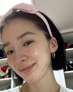 Irene Kim Instagram - Dear pimples, I’ve noticed recently you’ve been popping up quite frequently. If you’re going to live on my face, I need to see some rent.