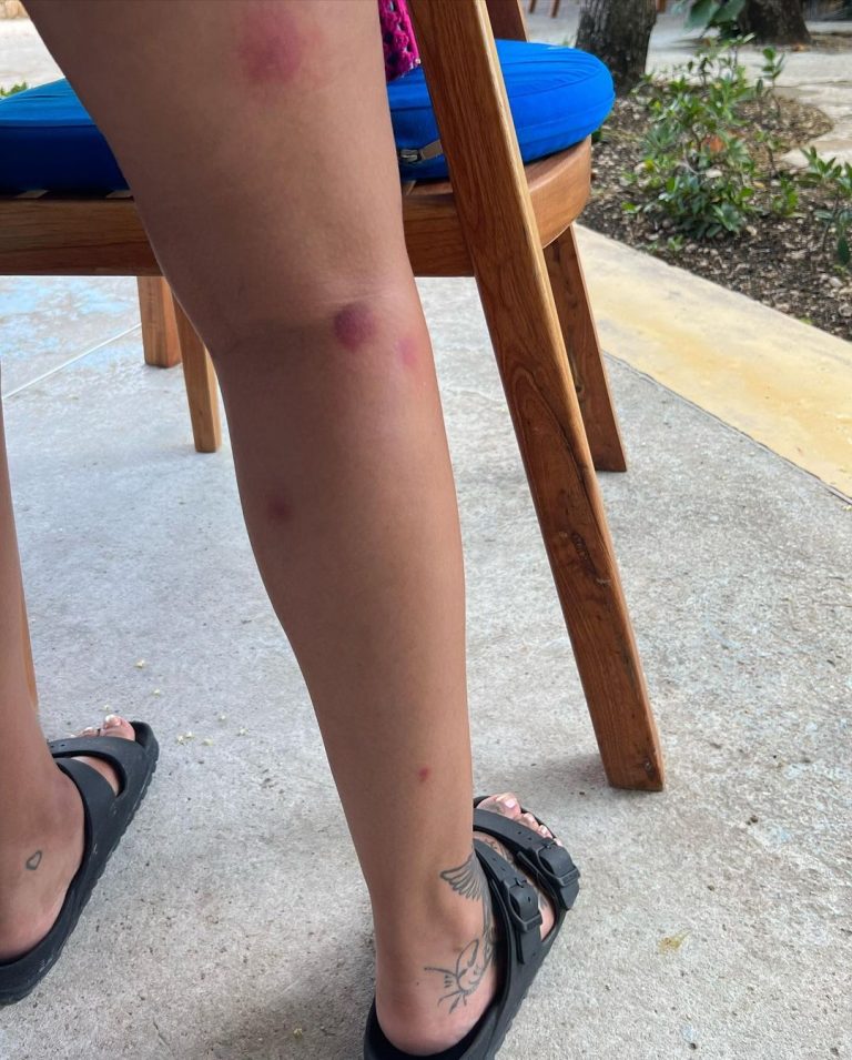 Jade Thirlwall Instagram - Turns out Jamaican mosquitos love biting me just as much as all the others 🥹🥰😏