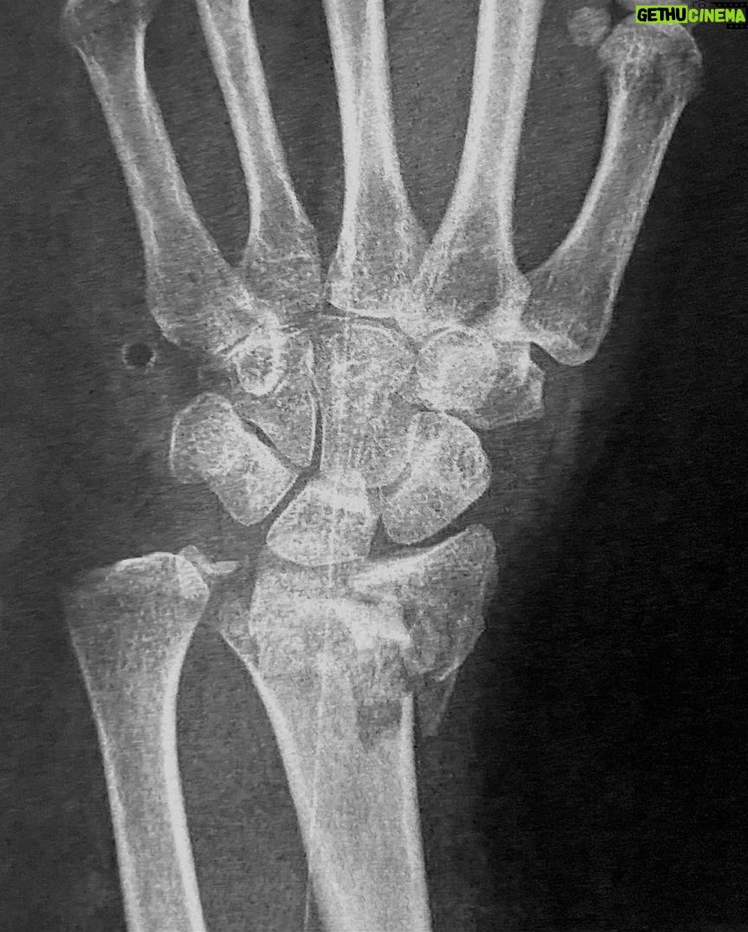 Jane De Leon Instagram - I know that it must be difficult especially as this is your 8th surgery (head, heart x4, legs and now your wrist). Every surgery is extra dangerous for you because of your heart problem. Yet here you are fightng for us. The scars on your body made us call you “Frankenstein Mom” to which you just answer with a smile. You’re such a strong person mama and I am proud of you. ❤️ THANK YOU FOR ALL THE PRAYERS EVERYONE! 🙏✨