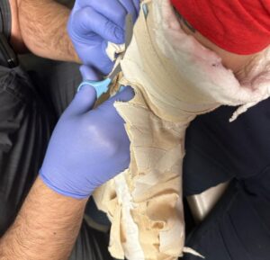 Johnny Knoxville Instagram - Thanks to Dr. E. for fixing my right arm good as new. At the end of 2022 I tore part of my right bicep off the bone and had to go in two weeks ago to get it all sewn back together. Will be another month before I am out of this Tron like brace but  it’s not so bad. Plus I kind of like the look of it.🤸🏻‍♀️