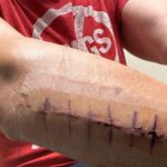 Johnny Knoxville Instagram - Thanks to Dr. E. for fixing my right arm good as new. At the end of 2022 I tore part of my right bicep off the bone and had to go in two weeks ago to get it all sewn back together. Will be another month before I am out of this Tron like brace but it’s not so bad. Plus I kind of like the look of it.🤸🏻‍♀️