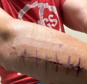 Johnny Knoxville Instagram - Thanks to Dr. E. for fixing my right arm good as new. At the end of 2022 I tore part of my right bicep off the bone and had to go in two weeks ago to get it all sewn back together. Will be another month before I am out of this Tron like brace but  it’s not so bad. Plus I kind of like the look of it.🤸🏻‍♀️