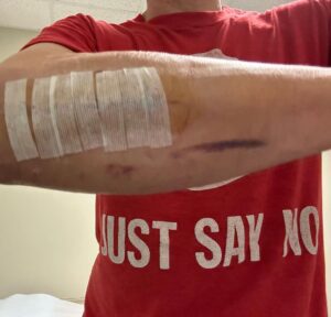 Johnny Knoxville Instagram - Thanks to Dr. E. for fixing my right arm good as new. At the end of 2022 I tore part of my right bicep off the bone and had to go in two weeks ago to get it all sewn back together. Will be another month before I am out of this Tron like brace but  it’s not so bad. Plus I kind of like the look of it.🤸🏻‍♀️
