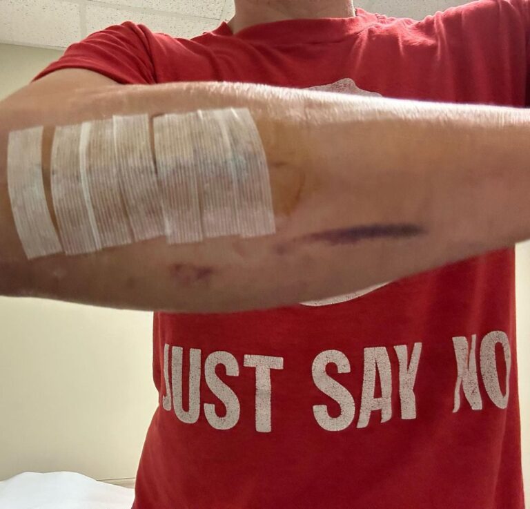 Johnny Knoxville Instagram - Thanks to Dr. E. for fixing my right arm good as new. At the end of 2022 I tore part of my right bicep off the bone and had to go in two weeks ago to get it all sewn back together. Will be another month before I am out of this Tron like brace but it’s not so bad. Plus I kind of like the look of it.🤸🏻‍♀️