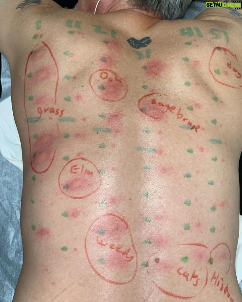 Johnny Knoxville Instagram - Got an allergy test yesterday for the first time in 15 years. Looks like nothing has changed!🤪🤣