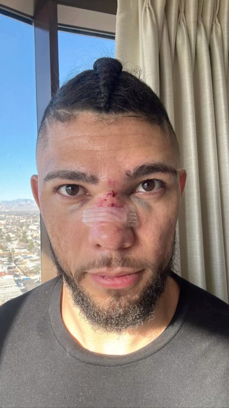 Johnny Walker Instagram - 2 weeks after fight . Speed recovery from a broken nose ! Was it fast? Foi rápido a recuperação? 2 semanas : nariz quebrado