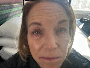 Katie Couric Instagram - Calling all sensitive skin sufferers! 🙋‍♀️ I’ve had eczema ever since I was a little girl, and as I've gotten older, it's started to flare up again. I also deal with allergic contact dermatitis — safe to say, I have to be careful about what I put on my face. My search for treatment led me to @cherylleemdisme. Her products have really helped. I asked Lee a lot of questions about what causes eczema and how to calm flare-ups. You can find all of her tips and tricks at the link in my bio. 🙌 (I can’t believe I let my team post this picture. Good Lord 🥴)

#sensitiveskin #skincare #skincareroutine #dermatologist #eczema