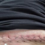 Mark Sheppard Instagram - So. Nasty little bout with skin cancer. Started as an ingrown… ended as an 8in wide gash in my belly. Squamous but not from sun damage. Moral of the story - “leave it, it’ll get better” apparently doesn’t work on me. #spnfamily