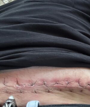 Mark Sheppard Instagram - So. Nasty little bout with skin cancer. Started as an ingrown… ended as an 8in wide gash in my belly. Squamous but not from sun damage. Moral of the story - “leave it, it’ll get better” apparently doesn’t work on me. #spnfamily