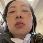 Matt McGorry Instagram – This is infuriating and unacceptable and why N95 masks need to be mandated in healthcare. High risk people should not have to risk death and having permanent, new health issues in trying to get the care they need. @ucsfhealth 

#Repost @disability_visibility
・・・
“Help me urge @ucsfhealth to require all staff, patients, and visitors to wear N95 masks 

#N95s4UCSF #KeepMasksInHealthcare 

Link in bio 

My recent column in Teen Vogue about the surge and its impact on me as a high risk disabled person became a terrifying reality when I had a medical emergency that required a visit to the ER and brief hospitalization in the ICU.

Disabled, immunocompromised, and chronically ill people know fully well that the world is not designed for us and how we are often dehumanized and considered burdens by the medical industrial complex. It is an exhausting struggle to be seen and heard while fighting to survive in the face of systemic oppression.

While I was in the hospital I tweeted some of my experiences because I needed to document what was happening and do something while filled with fear. 

Writing and organizing is a way to channel my rage and process my medical trauma.

I call upon you all to help me push for a N95 mask mandate at UCSF Health.

No one should have to delay care or risk infection from COVID when receiving necessary medical care.

Image description: A picture of me, an Asian American disabled woman. There is a tracheostomy at my throat connected to a ventilator tube. A white gauze dressing is tucked around the tracheostomy. I am wearing a camouflage jacket. My eyes are swollen after crying uncontrollably for hours and barely able to open. I look miserable.”