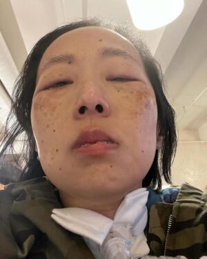 Matt McGorry Instagram - This is infuriating and unacceptable and why N95 masks need to be mandated in healthcare. High risk people should not have to risk death and having permanent, new health issues in trying to get the care they need. @ucsfhealth 

#Repost @disability_visibility
・・・
“Help me urge @ucsfhealth to require all staff, patients, and visitors to wear N95 masks 

#N95s4UCSF #KeepMasksInHealthcare 

Link in bio 

My recent column in Teen Vogue about the surge and its impact on me as a high risk disabled person became a terrifying reality when I had a medical emergency that required a visit to the ER and brief hospitalization in the ICU.

Disabled, immunocompromised, and chronically ill people know fully well that the world is not designed for us and how we are often dehumanized and considered burdens by the medical industrial complex. It is an exhausting struggle to be seen and heard while fighting to survive in the face of systemic oppression.

While I was in the hospital I tweeted some of my experiences because I needed to document what was happening and do something while filled with fear. 

Writing and organizing is a way to channel my rage and process my medical trauma.

I call upon you all to help me push for a N95 mask mandate at UCSF Health.

No one should have to delay care or risk infection from COVID when receiving necessary medical care.

Image description: A picture of me, an Asian American disabled woman. There is a tracheostomy at my throat connected to a ventilator tube. A white gauze dressing is tucked around the tracheostomy. I am wearing a camouflage jacket. My eyes are swollen after crying uncontrollably for hours and barely able to open. I look miserable.”