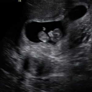 NF Instagram - Bringing a human into this world.
I’m going to be a dad.
The end.