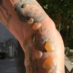 Steve-O Instagram - The most horrific pain I’ve ever been in…