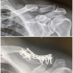 Steve-O Instagram - I’m about to go into surgery to remove two plates and a bunch of screws from my collarbone. Fun fact, today is exactly five years since the day I found @wendyfromperu on the streets of Peru (that’s her tattooed under my collarbone).