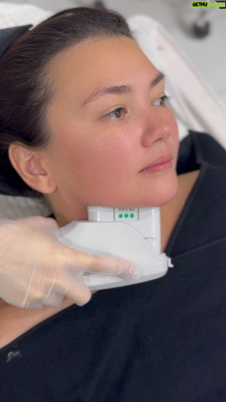 Angelica Panganiban Instagram - Join @iamangelicap as she elevates her beauty game with her annual Aivee Ulthera Maxx Lift! This time, sheโs targeting that double chin for a snatched, contoured jawline thatโs truly envy-worthy! ๐ซ โ
AIVEE ULTHERA MAXX LIFT is a facial lifting and skin tightening procedure that uses ultrasound to boost the production of collagen and elastin that gives the skin a noticeable lift and tightness. DISCLAIMER: Treatments and procedures depend upon consultation. We highly encourage our patients to be examined by our doctors for us to prescribe the proper treatments for your skin and body concern. Treatment costs may be discussed upon consultation. Book your appointment now by calling or sending us a message here! +639177283838 - Local Hotline +639614514572 - International Hotline +639692230499 - Whatsapp/Viber Or you may call our branches at: ๐ A-INSTITUTE, BGC: +63917 521 0222 ๐ FORT, BGC: +63920 966 5529 ๐ MEGAMALL: +63917 871 9500 ๐VERTIS NORTH: +63917 164 4170 ๐ ALABANG: +63917 537 4200 #aivee #theaiveeclinic #aiveeclinic #aiveeday #aiveelove #aiveeleague #draivee #drzteo #aiveeultheramaxxlift