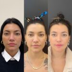 Gabrielle Prado Instagram - Tem tempo que tô pra postar esse antes e depois aqui das minhas cirurgias no nariz. mas hoje vou falar um pouquinho do processo! Outubro do ano passado fiz Septoplastia na @jkesteticaavancada devido a dificuldade que eu tinha de respirar e isso me atrapalhar muito no trabalho e no meu dia a dia (a clínica tem médicos profissionais excelentes que priorizam a sua saúde e lá foi o único local que me senti acolhida e confiante pra fazer esse procedimento). Depois de várias consultas, pedi ao Dr também que afinasse a ponta do meu nariz e desse uma empinada. ele fez maravilhosamente bem, só que eu não cumpri o pós e meu nariz acabou cedendo a ponta e inflamando muito. foi um processo longo (6 meses) de cuidados com a Jk e Abril desse ano refizemos a rino. Hoje, 2 meses depois esse é o resultado! não é o final, pq o Dr disse que pro resultado final, precisamos de 6 meses a 1 ano. no início confesso que foi difícil a adaptação, pq muda bastante, né? mesmo pq eu tenho brigado bastante com minha autoestima (depois falamos disso). só que hoje acordei e me olhei no espelho e me senti preparada pra compartilhar algo que tem sido bastante comentado por aqui. conforme os meses forem passando, eu vou mostrando a evolução pra vocês, ok? Qualquer dúvida só chamar o pessoal da @jkesteticaavancada beijo, mamãe ama! 💜 São Paulo, Brazil