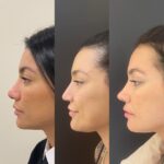 Gabrielle Prado Instagram – Tem tempo que tô pra postar esse antes e depois aqui das minhas cirurgias no nariz. mas hoje vou falar um pouquinho do processo! Outubro do ano passado fiz Septoplastia na @jkesteticaavancada devido a dificuldade que eu tinha de respirar e isso me atrapalhar muito no trabalho e no meu dia a dia (a clínica tem médicos profissionais excelentes que priorizam a sua saúde e lá foi o único local que me senti acolhida e confiante pra fazer esse procedimento). Depois de várias consultas, pedi ao Dr também que afinasse a ponta do meu nariz e desse uma empinada. ele fez maravilhosamente bem, só que eu não cumpri o pós e meu nariz acabou cedendo a ponta e inflamando muito. foi um processo longo (6 meses) de cuidados com a Jk e  Abril desse ano refizemos a rino. Hoje, 2 meses depois esse é o resultado!  não é o final, pq o Dr disse que pro resultado final, precisamos de 6 meses a 1 ano. no início confesso que foi difícil a adaptação, pq muda bastante, né? mesmo pq eu tenho brigado bastante com minha autoestima (depois falamos disso). só que hoje acordei e me olhei no espelho e me senti preparada pra compartilhar algo que tem sido bastante comentado por aqui. conforme os meses forem passando, eu vou mostrando a evolução pra vocês, ok? Qualquer dúvida só chamar o pessoal da @jkesteticaavancada 
beijo, mamãe ama! 💜 São Paulo, Brazil