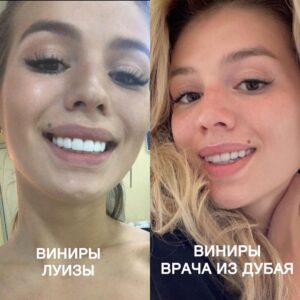 Lyudmila Chebotina Instagram - Я долго молчала!
И всячески избегала эту больную для меня тему, несмотря на огромный хейт и оскорбления по поводу моих прежних виниров.
Сегодняшнее интервью на Super.Ru «звездного» стоматолога Луизы дает мне право теперь говорить на эту тему открыто.
На фото слева - работа супер«звездного» российского стоматолога Луизы, клиника «Smile studio».
На фото справа - работа арабского стоматолога из Дубая. (И кстати, цена у этого доктора в два, а то и в три раза дешевле)
Помимо некрасивых виниров большого размера и ужасного унитазного цвета, который я, кстати, не выбирала (выбран мной был В2, а установлен А1), я получила себе: воспаление десны, гипертонус мышц лица, смещение челюстного сустава, кисты под железными коронками (которые, как оказалось, лечатся, а не как по её словам, только под удаление), а теперь еще и клевету в свой адрес.
3 года я переживала, плакала, параллельно подпиливала виниры, которые она мне понаставила, потому что физически не закрывался рот, и искала врача, который смог бы этот позор мне исправить, проходила разные обследования, чтобы понять, почему съехала челюсть. Обошла много врачей, и все в один голос говорили о том, что работа сделана очень плохо.
Луиза прекрасно знает причину, по которой я не стала делать ей рекламу (хоть и рекламу в сториз  делала постоянно на этапе подготовки). Это была бы уже анти-реклама для нее, так как комментарии через один под моими постами были «ужасные зубы», «лошадиная улыбка».
Все это время я молчала о том, кто сделал мне этот позор, знали в основном только свои. Менеджер по рекламе очень просил не подавать в суд и не начинать скандал, потому что она пользовалась услугами нашего рекламного агенства.
На мои просьбы переделать, несмотря на то, что сама Луиза меня и уговорила поставить виниры, она отвечала, что я придираюсь, надо просто к ним привыкнуть. Но привыкать к такому ужасу я не считаю нужным. 
А теперь я ещё взбалмошная дама, которая ее кинула.
Хотела рекламу?
Пожалуйста🫶🏻
Ну что?Кто хочет виниры от Луизы?