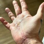 Tommy Lee Instagram - 5 weeks ago today surgery was done! 🙌🏼ealing 🙌🏼ands 🙌🏼ero @drcohenhandsurgeon