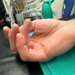 Tommy Lee Instagram - Well kids, it’s show n tell time… hope this doesn’t wreck your lunch 😂 only 3 weeks ago i underwent a hand surgery by @drcohenhandsurgeon He addressed 2 debilitating issues for me as a drummer, keyboard player and pretty much everything to do with my right hand. And yesterday was fucking monumental for me to the point of tears …. I have my life back and my money makers 🙌🏼 . And for you drummers and musicians out there i can say it’s possible to fix! And in the last clip I’m able to twirl my sticks again… i haven’t been able to do that in a few years because of the Dupytrens Contracture and carpal tunnel issues that are now gone! @drcohenhandsurgeon and the staff there I AM FOREVER GRATEFUL 🙏🏻