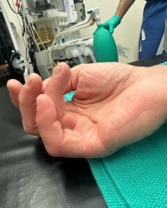 Tommy Lee Instagram - Well kids, it’s show n tell time… hope this doesn’t wreck your lunch 😂 only 3 weeks ago i underwent a hand surgery by @drcohenhandsurgeon He addressed 2 debilitating issues for me as a drummer, keyboard player and pretty much everything to do with my right hand. And yesterday was fucking monumental for me to the point of tears …. I have my life back and my money makers 🙌🏼 . And for you drummers and musicians out there i can say it’s possible to fix! And in the last clip I’m able to twirl my sticks again… i haven’t been able to do that in a few years because of the Dupytrens Contracture and carpal tunnel issues that are now gone! @drcohenhandsurgeon and the staff there I AM FOREVER GRATEFUL 🙏🏻
