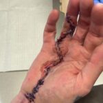 Tommy Lee Instagram - 5 weeks ago today surgery was done! 🙌🏼ealing 🙌🏼ands 🙌🏼ero @drcohenhandsurgeon