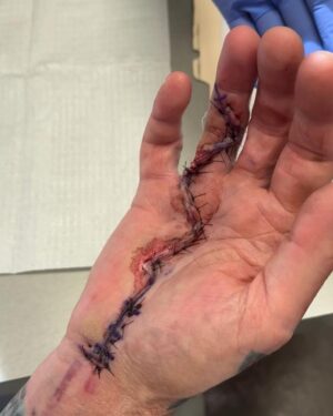 Tommy Lee Instagram - 5 weeks ago today surgery was done! 🙌🏼ealing 🙌🏼ands 🙌🏼ero @drcohenhandsurgeon
