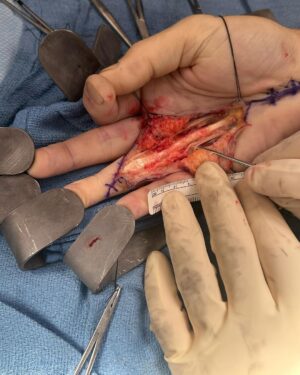 Tommy Lee Instagram - Well kids,  it’s show n tell time… hope this doesn’t wreck your lunch 😂 only 3 weeks ago i underwent a hand surgery by @drcohenhandsurgeon  He addressed 2 debilitating issues for me as a drummer, keyboard player and pretty much everything to do with my right hand. And yesterday was fucking monumental for me to the point of tears …. I have my life back and my money makers 🙌🏼 . And for you drummers and musicians out there i can say it’s possible to fix! And in the last clip I’m able to twirl my sticks again… i haven’t been able to do that in a few years because of the Dupytrens Contracture and carpal tunnel issues that are now gone!  @drcohenhandsurgeon  and the staff there I AM FOREVER GRATEFUL 🙏🏻