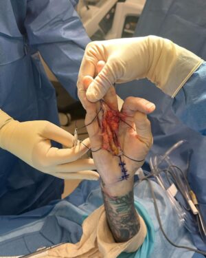 Tommy Lee Instagram - Well kids,  it’s show n tell time… hope this doesn’t wreck your lunch 😂 only 3 weeks ago i underwent a hand surgery by @drcohenhandsurgeon  He addressed 2 debilitating issues for me as a drummer, keyboard player and pretty much everything to do with my right hand. And yesterday was fucking monumental for me to the point of tears …. I have my life back and my money makers 🙌🏼 . And for you drummers and musicians out there i can say it’s possible to fix! And in the last clip I’m able to twirl my sticks again… i haven’t been able to do that in a few years because of the Dupytrens Contracture and carpal tunnel issues that are now gone!  @drcohenhandsurgeon  and the staff there I AM FOREVER GRATEFUL 🙏🏻