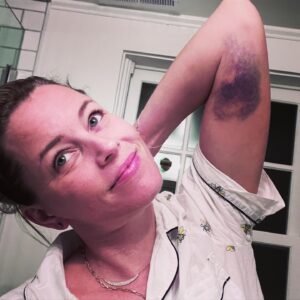 Elizabeth Banks Instagram - Late night archery bruise update. I feel it’s moving in the healing direction. Blessings to all.