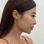 Keerati Mahapreukpong Instagram - 🖤 1 ในการดูแลตัวเองที่ต้อง maintain มาตลอดคือbotox 🫶🏽 วันนี้มาเก็บครบทั้ง โบริ้วรอย/ โบกราม / โบลิฟติ้ง. หมอมือเบาสุดๆ ( ใครกลัวเจ็บ เค้ามีเข็มเล็กพิเศษนะ! ) ประทับใจ การฉีดลิฟติ้งกรอบหน้าของคุณหมอมาก ละเอียดสุดๆ แถมบรรจงเรียงตุ่มสวยมาก!! 😳🤍 ใครอยากกรอบหน้าชัด ถ่ายรูปง่ายขึ้น หรือ อยากป้องกันริ้วรอย ลองแวะมาฉีดตามยิปกันได้นะ~ ;)) 👍🏽🖤✨