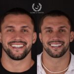 Arthur Picoli Instagram - Há algum tempo eu buscava um meio para melhorar meu sorriso e consequentemente minha autoestima. E foi com o contato do meu amigo @drviotto que eu me interessei em saber mais sobre as lentes de porcelana. Ele, junto com a @dra.alinecolli , me apresentaram o projeto e eu fiquei apaixonado pela naturalidade das peças e da coloração. Sempre deixei bem claro que buscava algo natural, apenas para realçar meu sorriso (já que sou um cara risonho kkk), e confesso que o resultado final me deixou feliz demaaaaaais. Obrigado @clinicaviottocuritiba por proporcionar esse upgrade e me fazer perder o medo de dentista. 😂❤️ Passa pro lado aí para conferir essa mudança! ❤️