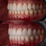 Arthur Picoli Instagram - Há algum tempo eu buscava um meio para melhorar meu sorriso e consequentemente minha autoestima. E foi com o contato do meu amigo @drviotto que eu me interessei em saber mais sobre as lentes de porcelana. Ele, junto com a @dra.alinecolli , me apresentaram o projeto e eu fiquei apaixonado pela naturalidade das peças e da coloração. Sempre deixei bem claro que buscava algo natural, apenas para realçar meu sorriso (já que sou um cara risonho kkk), e confesso que o resultado final me deixou feliz demaaaaaais. Obrigado @clinicaviottocuritiba por proporcionar esse upgrade e me fazer perder o medo de dentista. 😂❤️ Passa pro lado aí para conferir essa mudança! ❤️