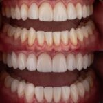 Arthur Picoli Instagram - Há algum tempo eu buscava um meio para melhorar meu sorriso e consequentemente minha autoestima. E foi com o contato do meu amigo @drviotto que eu me interessei em saber mais sobre as lentes de porcelana. Ele, junto com a @dra.alinecolli , me apresentaram o projeto e eu fiquei apaixonado pela naturalidade das peças e da coloração. Sempre deixei bem claro que buscava algo natural, apenas para realçar meu sorriso (já que sou um cara risonho kkk), e confesso que o resultado final me deixou feliz demaaaaaais. Obrigado @clinicaviottocuritiba por proporcionar esse upgrade e me fazer perder o medo de dentista. 😂❤️ Passa pro lado aí para conferir essa mudança! ❤️