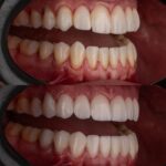 Arthur Picoli Instagram - Há algum tempo eu buscava um meio para melhorar meu sorriso e consequentemente minha autoestima. E foi com o contato do meu amigo @drviotto que eu me interessei em saber mais sobre as lentes de porcelana. Ele, junto com a @dra.alinecolli , me apresentaram o projeto e eu fiquei apaixonado pela naturalidade das peças e da coloração. Sempre deixei bem claro que buscava algo natural, apenas para realçar meu sorriso (já que sou um cara risonho kkk), e confesso que o resultado final me deixou feliz demaaaaaais. Obrigado @clinicaviottocuritiba por proporcionar esse upgrade e me fazer perder o medo de dentista. 😂❤️ Passa pro lado aí para conferir essa mudança! ❤️