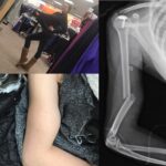 Blair Fowler Instagram - No I'm not pregnant with a water buffalo… For those of you who haven't been keeping up with me on other social media sites, I broke my arm ice skating in Central Park the day after Christmas. It's my right humerus which is the big bone in your arm that connects your shoulder to your elbow. I have absolutely no control over my right arm and very little mobility in my hand. Right now it's set in a huge cast contraption thing that sticks out and makes me look like I'm about to birth a wooly mammoth. I find out on Tuesday if the bone is going to mend itself in the cast or if I'll need to have surgery. I'll keep you guys posted. For now I'm healing in Tennessee surrounded by my family and trying to figure out how to do simple things one handed *today I opened the mouthwash bottle all by myself and it was a victory.* I have a fun video planned that I want to film as soon as I feel up to it. Love you all 😘🙅🏻⛸