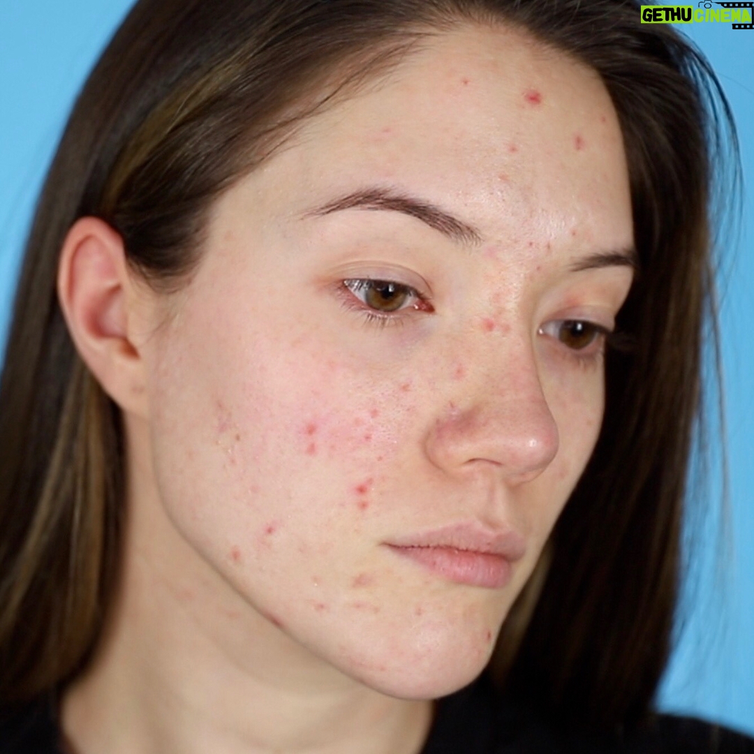 Blair Fowler Instagram - New video is up on my channel! It's a foundation routine for oily, acne prone skin with full coverage that will last all day! Swipe to see my skin before the layers of magic lol. Link is where the links go... in my bio ✨