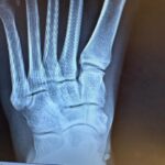 Candace Parker Instagram - Bones heal….. eventually! Life goes on…..To say I was devastated by my injury is an understatement. I was shattered. But my people held me up. And for that…. I’m grateful ❤️ #4Life