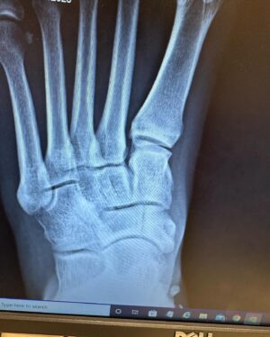 Candace Parker Instagram - Bones heal….. eventually! Life goes on…..To say I was devastated by my injury is an understatement. I was shattered. But my people held me up. And for that…. I’m grateful ❤️ #4Life