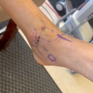 Candace Parker Instagram - Bones heal….. eventually! Life goes on…..To say I was devastated by my injury is an understatement. I was shattered. But my people held me up. And for that…. I’m grateful ❤️ #4Life